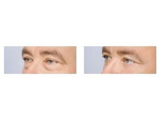 Blefaroplastyka przed i po - 876050