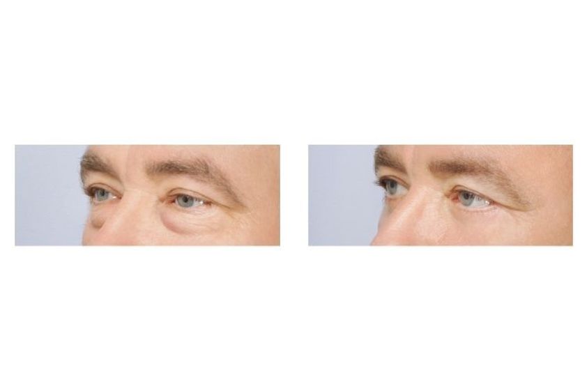 Blefaroplastyka przed i po - 876050
