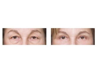Blefaroplastyka przed i po - 876057