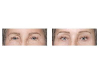 Blefaroplastyka przed i po - 876062