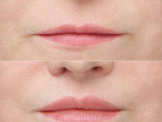 Lip Lift przed i po - 879220