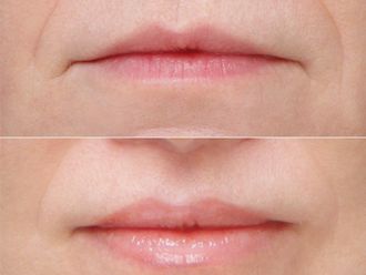 Lip Lift przed i po - 879221