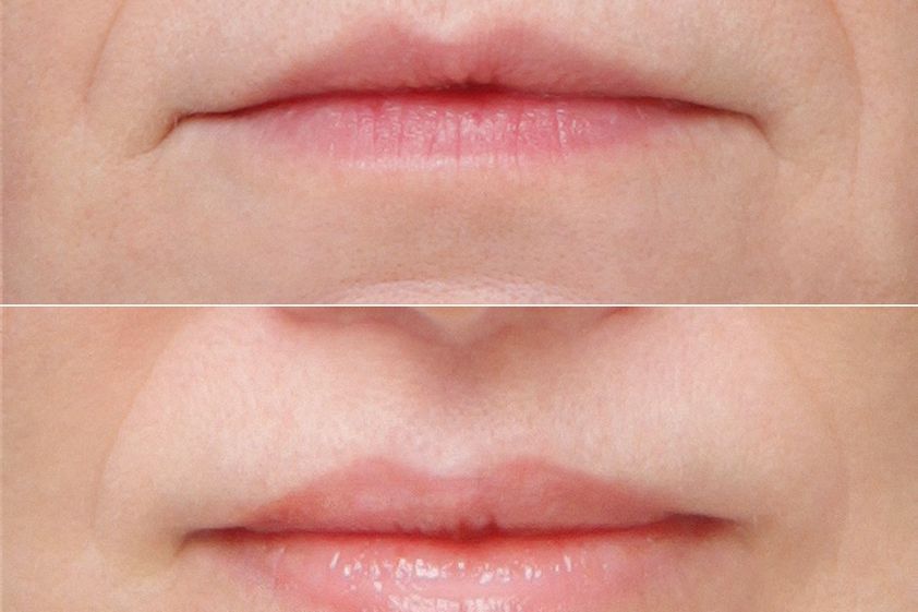 Lip Lift przed i po - 879221