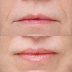 liplift - lek. med. Jakub Miszczyk