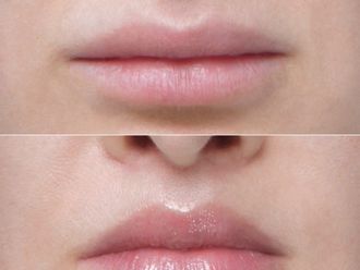 Lip Lift przed i po - 879222