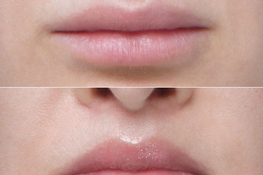 Lip Lift przed i po - 879222
