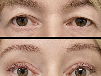 Blefaroplastyka przed i po - 879490
