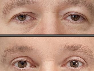 Blefaroplastyka przed i po - 879491