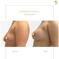 Powiększanie biustu - Centrum Medyczne Bieńkowski