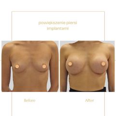 Powiększanie biustu - Centrum Medyczne Bieńkowski