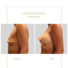 Powiększanie biustu - Centrum Medyczne Bieńkowski