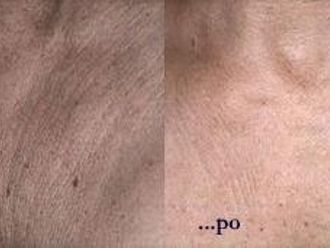 Peeling chemiczny - 652776