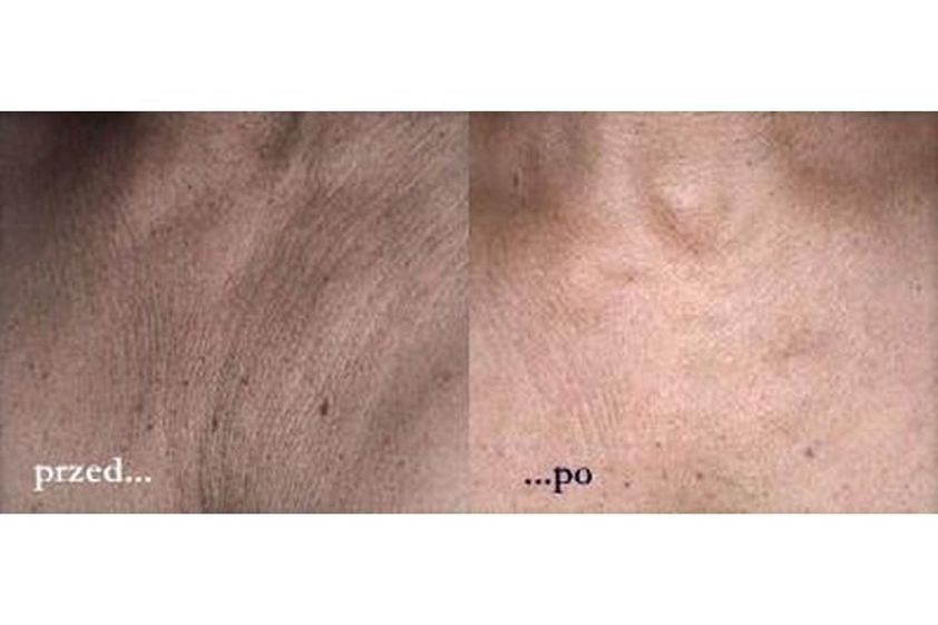 Peeling chemiczny przed i po - 686263