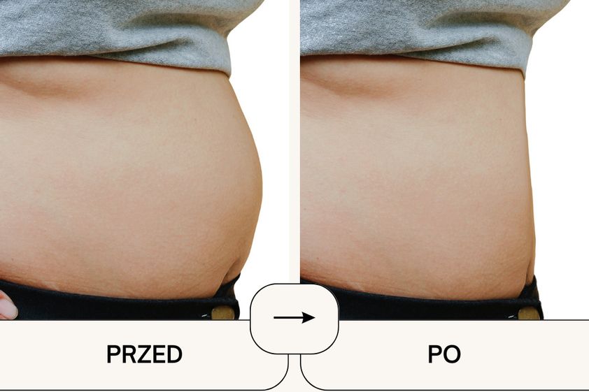 Liposukcja przed i po - 864494