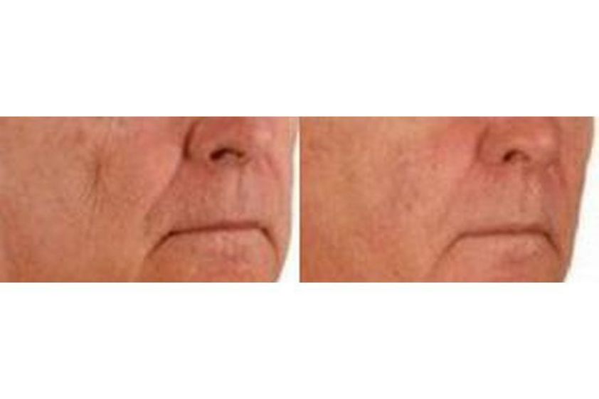 Anti-aging przed i po - 688393