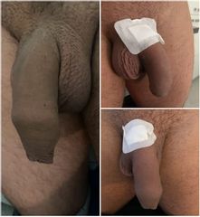 Powiekszenie penisa - na górze efekt po 20 ml, na dole po 40 ml - DCG Centrum Medyczne
