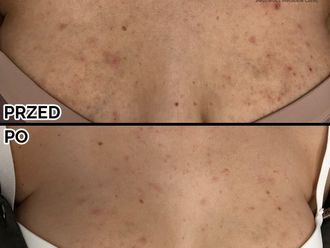 Laserowe zabiegi dermatologii estetycznej przed i po - 796382