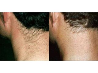 Przed i po - depilacja laserowa
