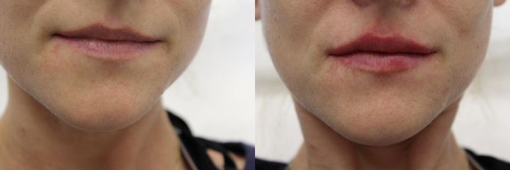 Powiększanie ust kwasem hialuronowym - przed i po