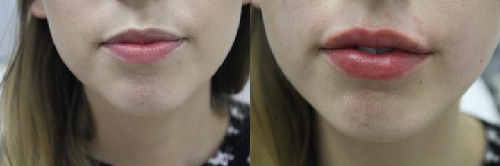 Powiększanie ust kwasem hialuronowym - przed i po