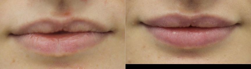 Powiększanie ust kwasem hialuronowym Neauvia Lips - przed i po
