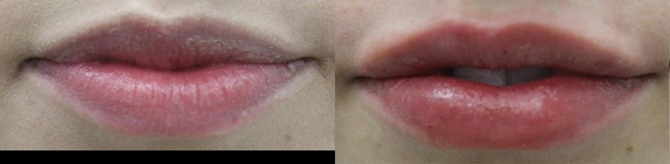 Powiększanie ust kwasem hialuronowym Neauvia Lips - przed i po