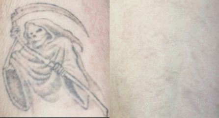Laserowe usuwanie tatuażu - przed i po