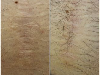 Laserowe leczenie trądziku przed i po - 850806