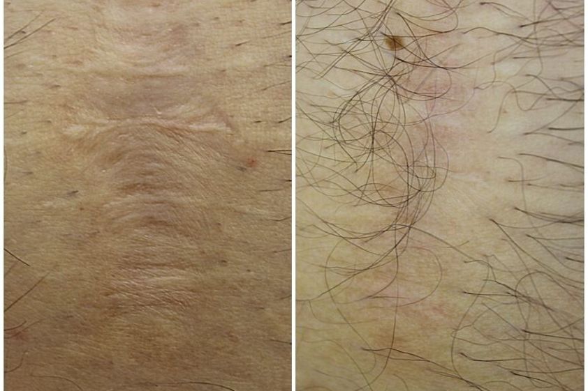 Laserowe leczenie trądziku przed i po - 850806