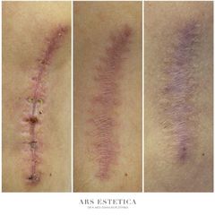 Laserowe leczenie trądziku - dr n. med. Diana Kupczyńska