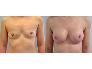 Powiększenie piersi implantami anatomicznym: przed i po