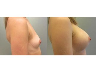 Powiększenie piersi implantami anatomicznymi: przed i po
