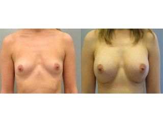 Powiększenie piersi implantami anatomicznymi: przed i po