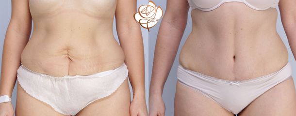 Plastyka brzucha - dr n.med. Daria Charytonowicz - Klinika Dr Szczyt