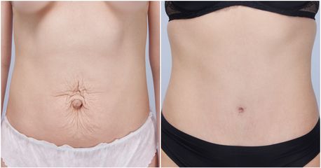 Plastyka brzucha - dr n. med. Daria Charytonowicz