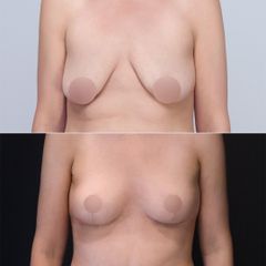 Podniesienie piersi
