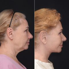 Deep Plane Facelift