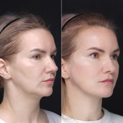Deep plane facelift