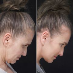 Deep Plane Face Lifting - dr n. med. Daria Charytonowicz