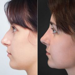 korekcja nosa - dr n. med. Daria Charytonowicz