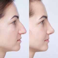 korekcja nosa - dr n. med. Daria Charytonowicz