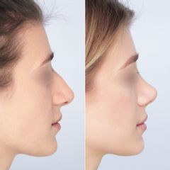 korekcja nosa - dr n. med. Daria Charytonowicz