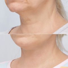 lift szyja - dr n. med. Daria Charytonowicz