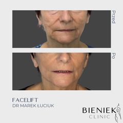 Lifting twarzy - Bieniek Clinic