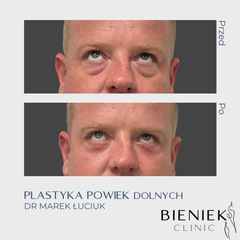 Blefaroplastyka - Bieniek Clinic