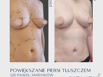 Powiększanie biustu tłuszczem przed i po - 858731