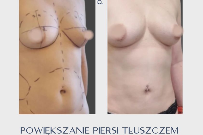 Powiększanie biustu tłuszczem przed i po - 858731