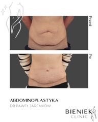 ABDOMINOPLASTYKA_DRPAWELJAREMKOW