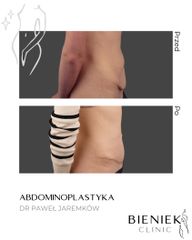 ABDOMINOPLASTYKA2-DRPAWEŁJAREMKÓW