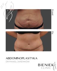 ABDOMINOPLASTYKA3-DRPAWELJAREMKOW